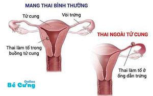 dau-bung-khi-mang-thai-1
